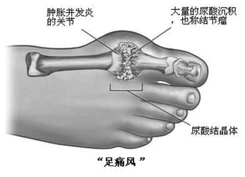 治痛风只管住嘴还不够